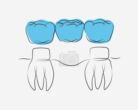 Téléchargez les illustrations : Dents avec dessin d'illustration de pont couronne dans un style linéaire sur fond blanc et bleu - en licence libre de droit