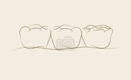 Téléchargez les illustrations : Dents implantées avec dessin d'illustration de pont couronne en style linéaire sur fond beige - en licence libre de droit