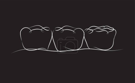 Illustration for Implanted teeth with crown bridge illustration drawing in linear style on black background - Royalty Free Image