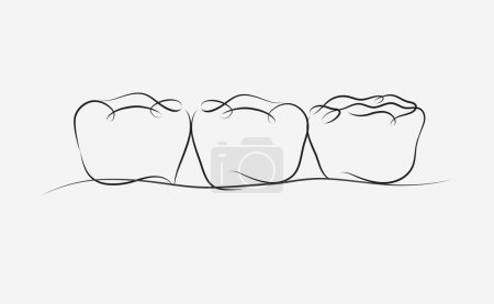 Téléchargez les illustrations : Dents implantées avec dessin d'illustration de pont couronne dans un style linéaire sur fond blanc - en licence libre de droit