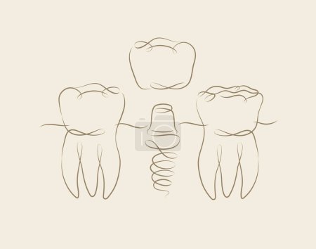 Téléchargez les illustrations : Dents implant illustration dessin en style linéaire sur fond beige - en licence libre de droit