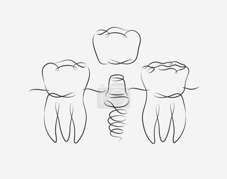 Téléchargez les illustrations : Dents implant illustration dessin en style linéaire sur fond blanc - en licence libre de droit