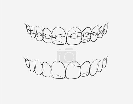 Illustration for Jaws with and without braces installed drawing in linear style on white background - Royalty Free Image
