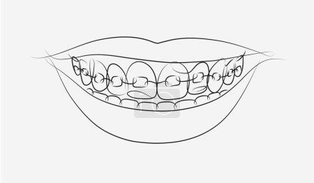 Illustration for Smile with teeth braces in linear style drawing on white background - Royalty Free Image
