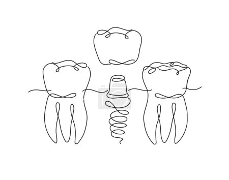 Téléchargez les illustrations : Dents implant illustration dessin dans le style ligne plate sur fond blanc - en licence libre de droit