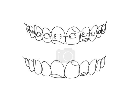 Illustration for Jaws with and without braces installed drawing in flat line style on white background - Royalty Free Image