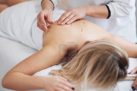 Téléchargez les photos : Une thérapie par aiguille à l'acupuncture en studio. Photo de haute qualité - en image libre de droit