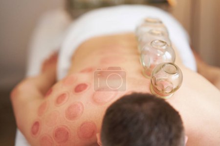 Photo for A picture of a man having cupping therapy. High quality photo - Royalty Free Image