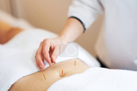 Téléchargez les photos : Une thérapie par aiguille à l'acupuncture en studio. Photo de haute qualité - en image libre de droit