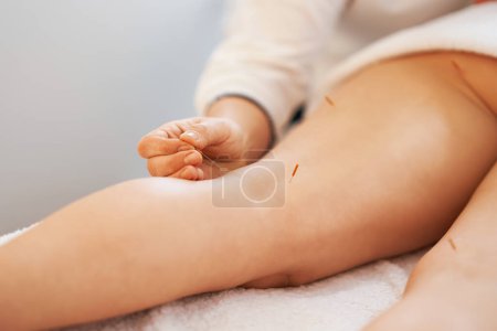 Photo for A acupuncture needle therapy in the studio. High quality photo - Royalty Free Image