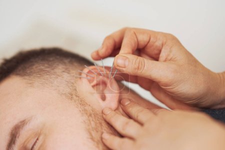 Téléchargez les photos : Une photo d'un homme ayant une acupuncture à l'oreille. Photo de haute qualité - en image libre de droit