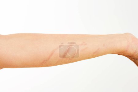 Photo for Pictures of female body skin burned skin burned by jellyfish Portuguese man o war. High quality photo - Royalty Free Image