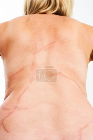 Bilder weiblicher Körperhaut verbrannte Haut durch Quallen portugiesischen Mann o Krieg. Hochwertiges Foto