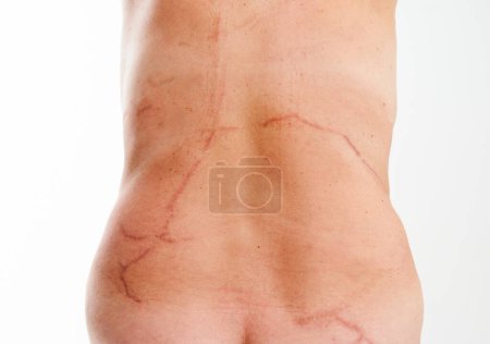 Téléchargez les photos : Photos de la peau du corps féminin brûlé peau brûlée par les méduses Portugais homme o guerre. Photo de haute qualité - en image libre de droit