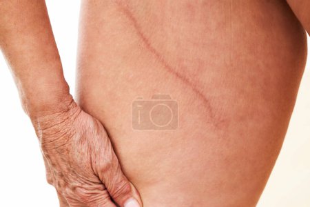 Photos de la peau du corps féminin brûlé peau brûlée par les méduses Portugais homme o guerre. Photo de haute qualité