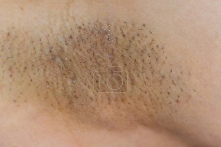 Mujer asiática teniendo problemas de piel con axilas negras