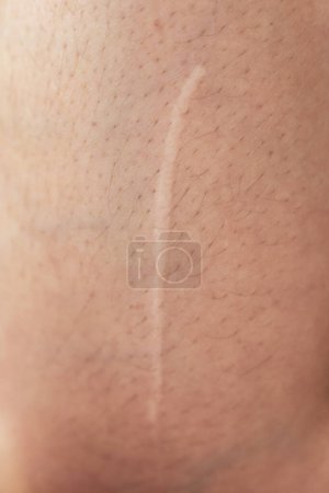 Photo for Close up of cyanotic keloid scar caused by surgery and suturing - Royalty Free Image