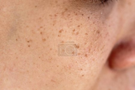 Téléchargez les photos : Pores de peau problématiques de la femme et taches sombres sur le visage - en image libre de droit