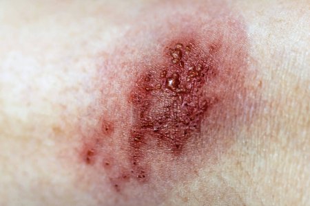 Téléchargez les photos : Virus du zona infecté par la peau - en image libre de droit