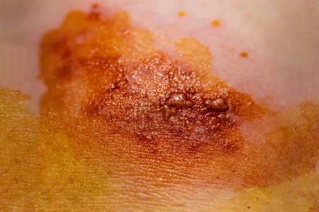 Téléchargez les photos : Virus du zona infecté par la peau - en image libre de droit