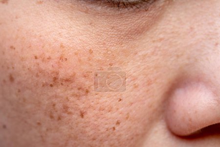 Pores de peau problématiques de la femme et taches sombres sur le visage
