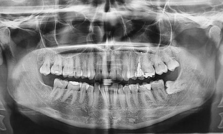 Foto de Radiografía dental con muela del juicio impactada - Imagen libre de derechos