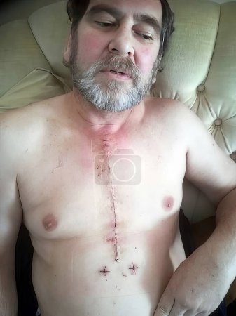 Foto de Imagen real del pecho de un hombre pocos días después de recibir una cirugía a corazón abierto con puntos disueltos - Imagen libre de derechos