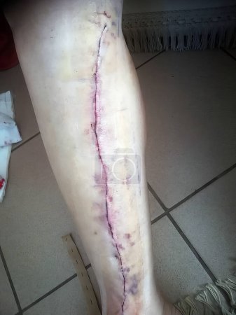 Foto de Imagen de cerca real de la pierna de un hombre después de recibir una cirugía de bypass cardíaco usando venas de sus piernas usando puntos disueltos - Imagen libre de derechos