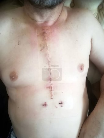 Foto de Imagen real del pecho de un hombre pocos días después de recibir una cirugía a corazón abierto con puntos disueltos - Imagen libre de derechos