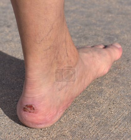 Links menschlicher Fuß mit einer Verletzung der Fersenrückseite aufgrund unsachgemäß montierter Wanderschuhe. Diese Art von Verletzungen ist bei Langstreckenwanderern häufig. Das Tragen von Stiefelfutter unter den Socken kann diese Verletzungen lindern.