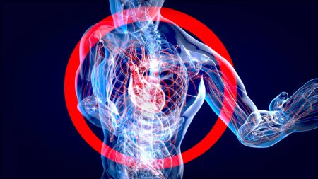 Foto de Abstract 3D illustration of a heart attack, health - Imagen libre de derechos