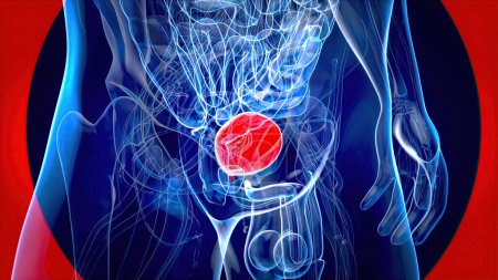Photo for Abstract 3D illustration of the bladder cancer - Royalty Free Image