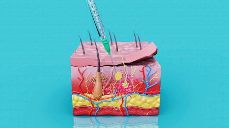 Téléchargez les photos : Illustration abstraite d'une injection sous-cutanée - en image libre de droit