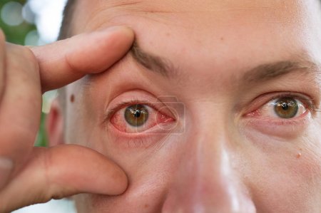 Un primer plano irritó los ojos rojos infectados, conjuntivitis. Inflamación de los ojos en los hombres