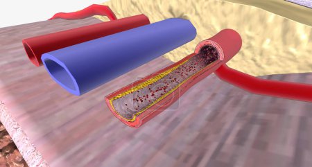 Atherosclerosis Progression in the Penis 3D rendering