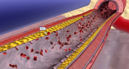 Atherosclerosis Progression in the Penis 3D rendering
