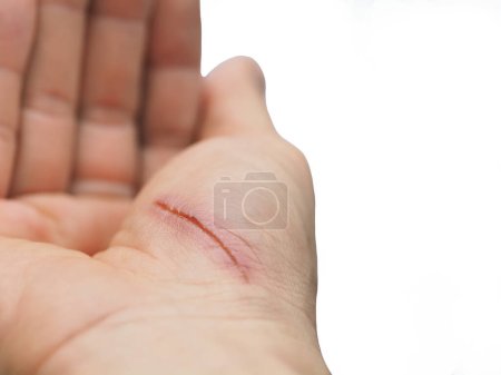 wounded palm on right hand on white background with copy space
