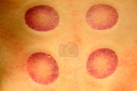 cupping therapy, Chinese traditional medical method marks on the skin, closeup of phot