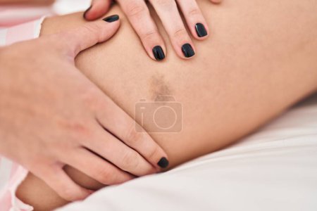 Photo for Young blonde woman touching leg with hematoma at bedroom - Royalty Free Image