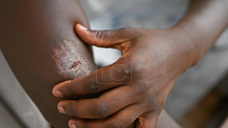 Photo for African american man sitting on sofa touching wound on arm at home - Royalty Free Image