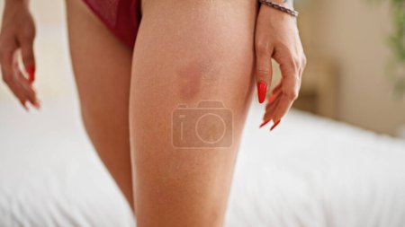 Photo for Young blonde woman wearing lingerie standing with hematoma on leg at bedroom - Royalty Free Image