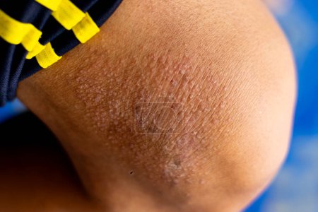 Erupción cutánea causada por la piel alérgica al sudor, polvo y virus.