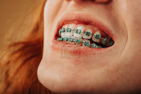 Gros plan de gingembre fille montrant ses dents avec des bretelles