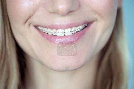 Closeup photo of a woman with nice smile and ceramic braces on teeth. Dental industry. Orthodontic patient. Teeth health concept.