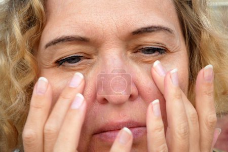 Foto de Ojo de mujer de mediana edad con párpado caído haciendo masaje facial. La ptosis es una caída del párpado superior, ojo perezoso. Cosmetología y concepto facial, primeras arrugas, primer plano - Imagen libre de derechos