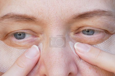 Foto de Ojo de mujer de mediana edad con párpado caído con parche para ojos. La ptosis es una caída del párpado superior, ojo perezoso. Cosmetología y concepto facial, primeras arrugas, primer plano - Imagen libre de derechos