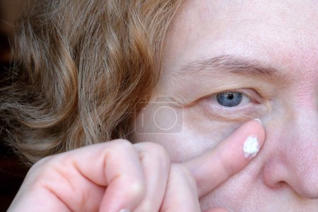 Weibliches Auge mittleren Alters mit hängendem Augenlid mit cremefarbenem kosmetischen Tropfen im Finger. Ptosis ist eine Hängung des Oberlids, faules Auge. Kosmetologie und Gesichtskonzept, erste Falten, Nahaufnahme