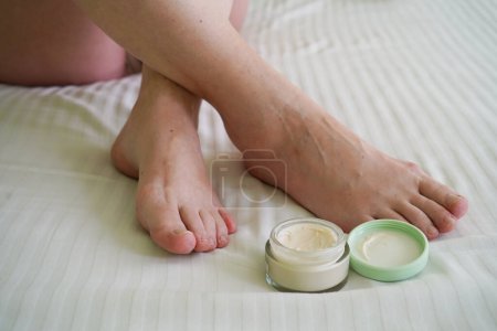 Téléchargez les photos : Jambes féminines avec problème avec les pieds des femmes et cosmétique crème, orteils d'oignon dans les pieds nus. Hallus valgus, gros plan - en image libre de droit