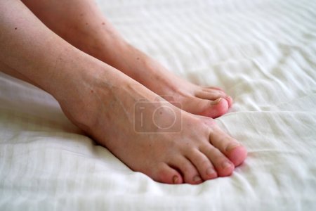 Photo for Female legs with problem with women's feet, bunion toes in bare feet. Hallus valgus, closeup - Royalty Free Image