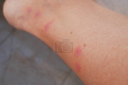 Téléchargez les photos : Piqûres de moustiques tiques sur les jambes de la femme, la maladie de Lyme, gros plan - en image libre de droit